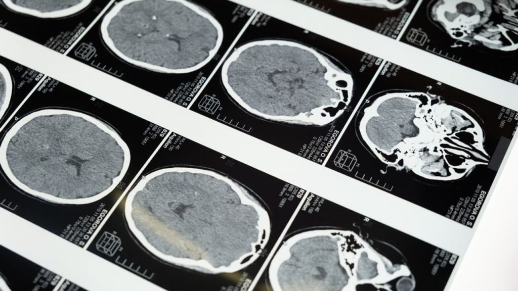 What Is Cerebrolysin Used For in Neuroscience