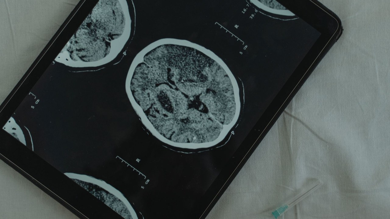 What Is PT-141 Peptide and Its Neurological Effects